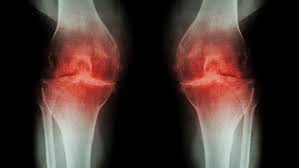 Un análisis de sangre detecta la artrosis ocho años antes que los rayos X.