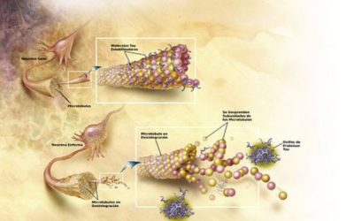 El alzhéimer podría estar relacionado con infecciones por hongos.