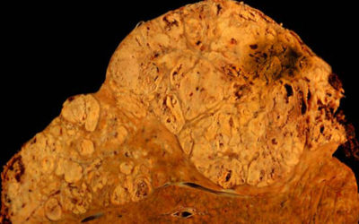 Niveles bajos de selenio se asocian con el desarrollo de cáncer de hígado.