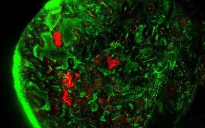 Dibujan el primer atlas que describe asociaciones entre tumores y hongos.