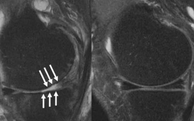 Músculos más fuertes pueden prevenir la cirugía de reemplazo de rodilla.